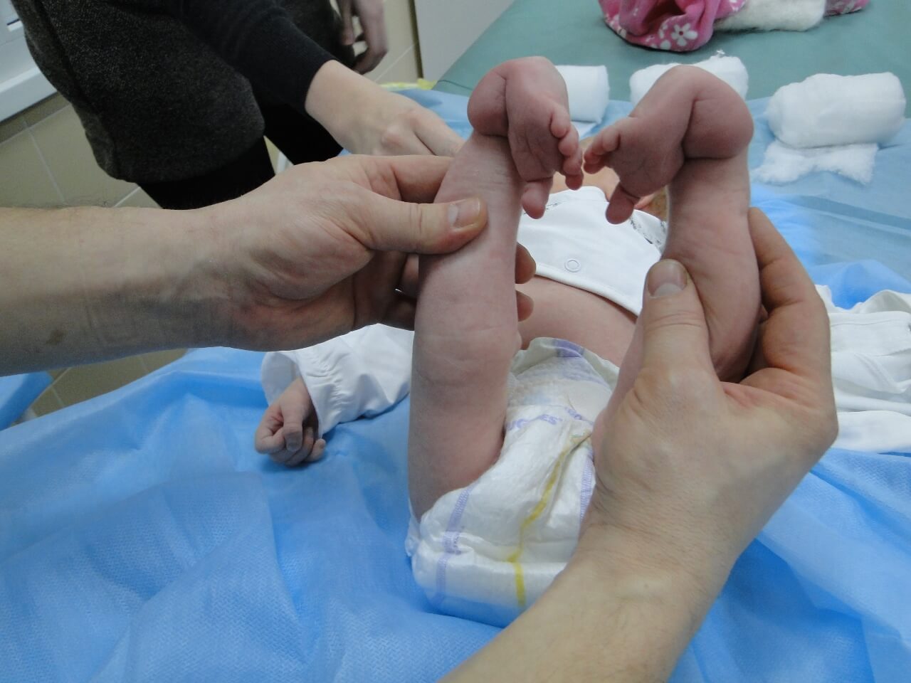 ребенок с синдромом Ларсена 