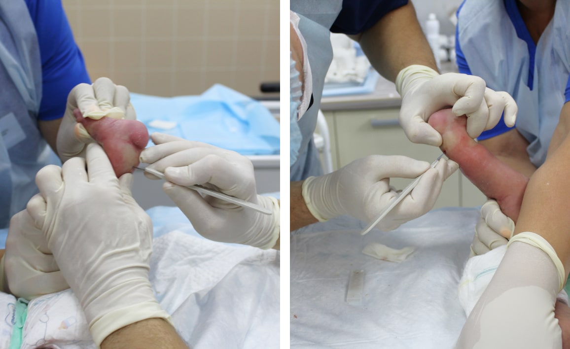 Что такое ахиллотомия и когда ее проводят?