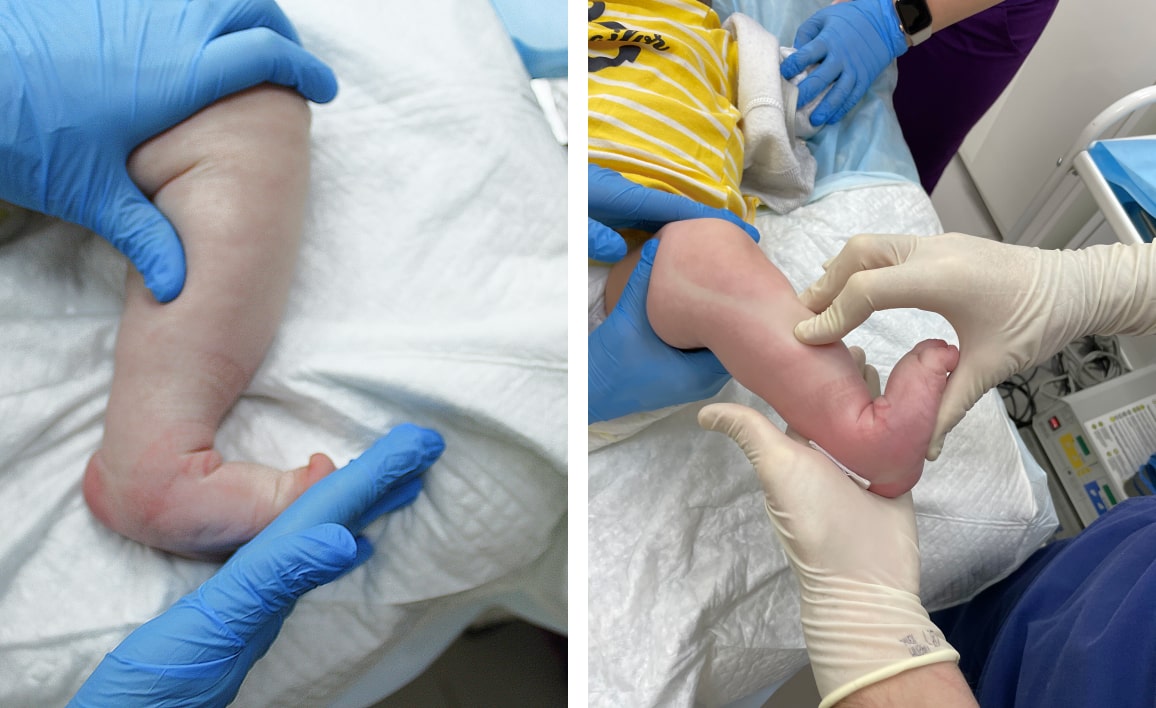 Что такое ахиллотомия и когда ее проводят?