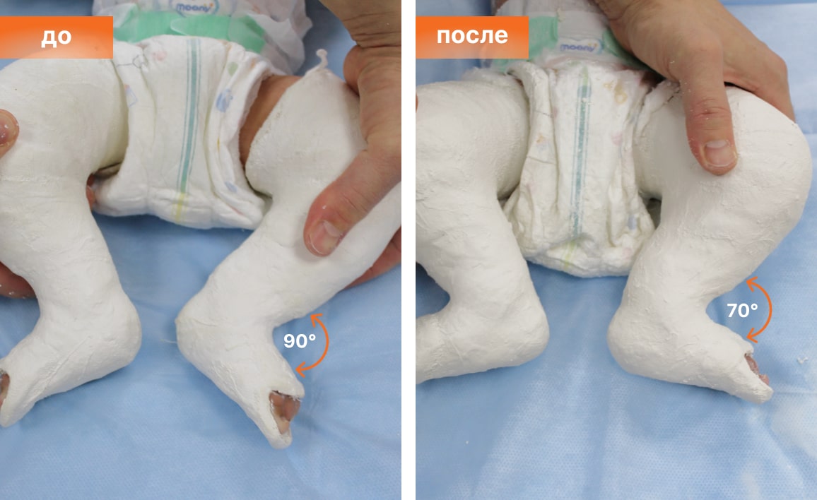 Что такое ахиллотомия и когда ее проводят?