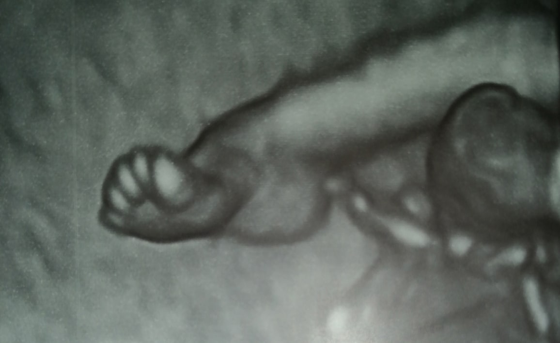 Деформация стопы плода на УЗИ во время беременности Деформация стопы плода на УЗИ во время беременности