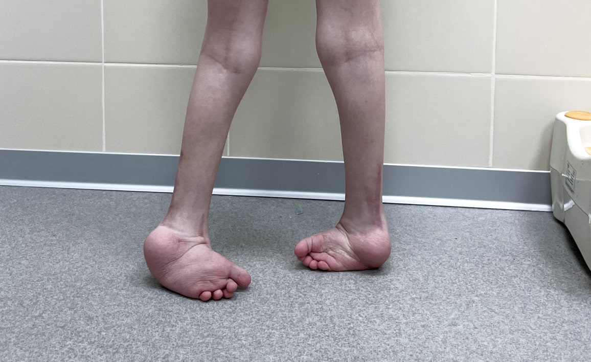 Что будет, если не лечить косолапость у ребенка