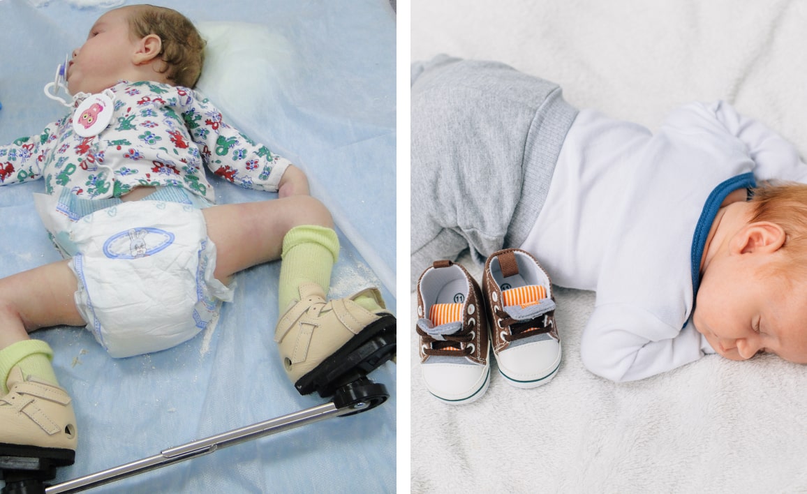 Лечение косолапости у детей при артрогрипозе Лечение косолапости у детей при артрогрипозе