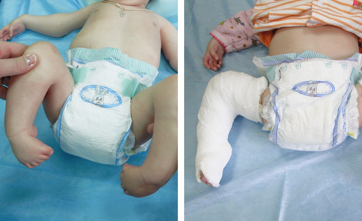 Лечение косолапости у детей при артрогрипозе Лечение косолапости у детей при артрогрипозе