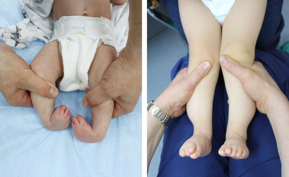 Эффективность коррекции косолапости при артрогрипозе и дальнейшая тактика Эффективность коррекции косолапости при артрогрипозе и дальнейшая тактика