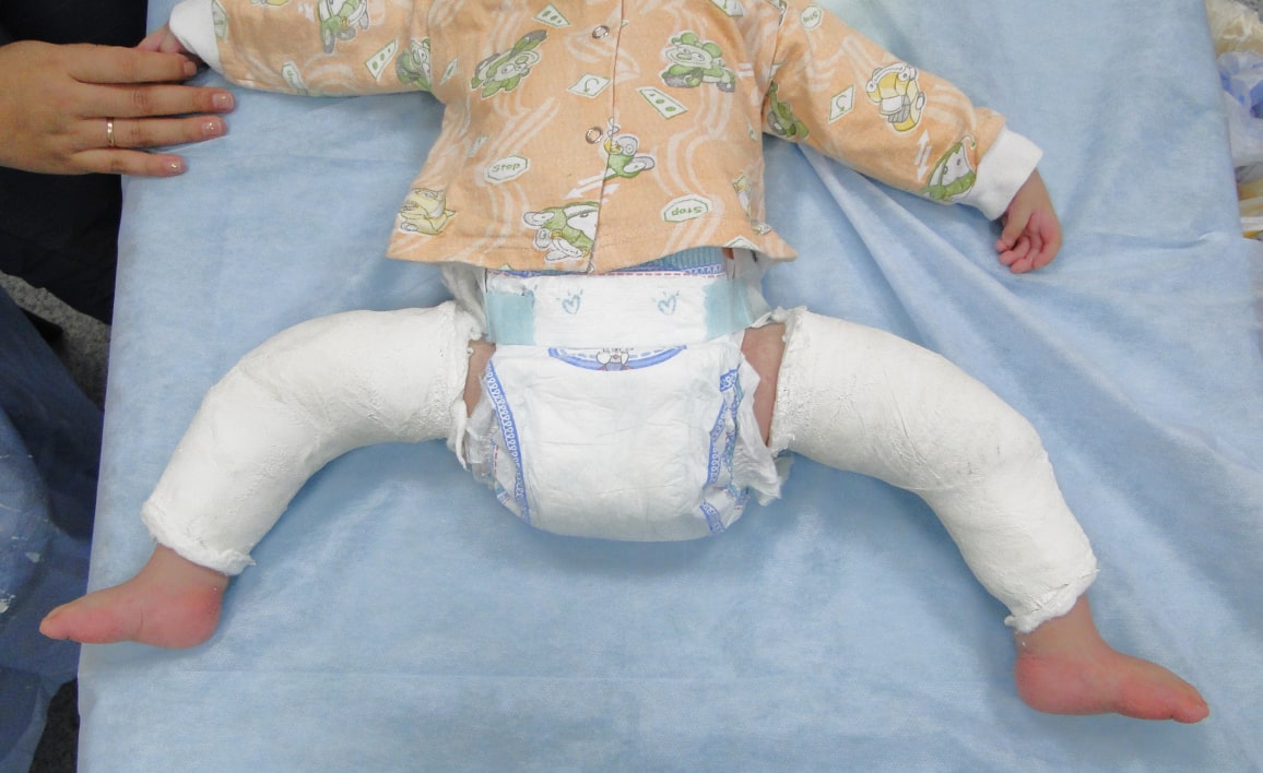 Лечение косолапости у детей при артрогрипозе Лечение косолапости у детей при артрогрипозе