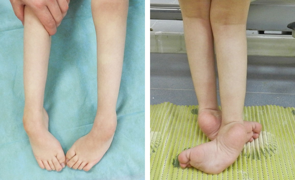 Нейрогенная косолапость у детей