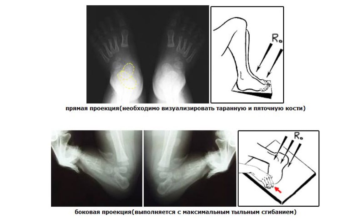 Рентген при косолапости Рентген при косолапости