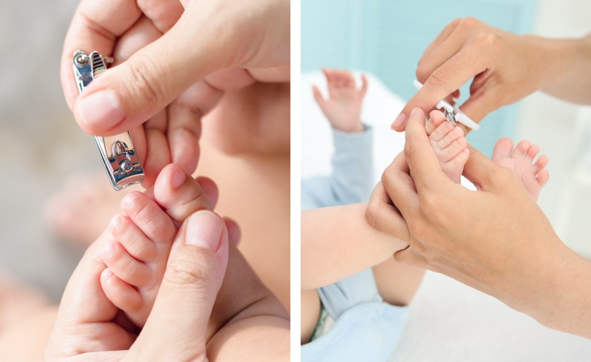 Вросший ноготь при лечении косолапости