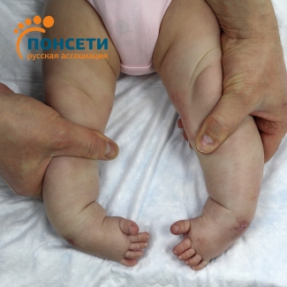 ятрогенная двухсторонняя косолапость