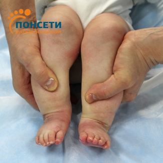 ятрогенная двухсторонняя косолапость