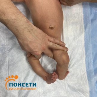 Синдром Ларсена. Множестенные ВАР верхних и нижних конечностей.