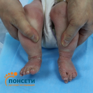 Синдром Ларсена. Множестенные ВАР верхних и нижних конечностей.