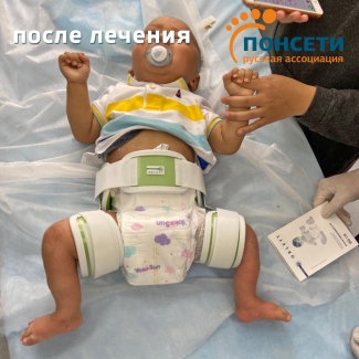 Врожденная ятрогенная тяжёлая атипичная косолапость с 2-х сторон. Тератогенный вывих левого тазобедренного сустава.