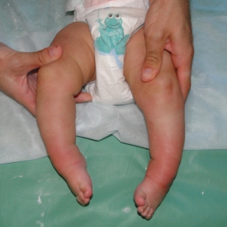 врожденная тяжелая двухсторонняя косолапость