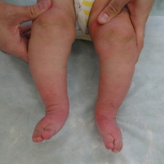 врожденная тяжелая двухсторонняя косолапость