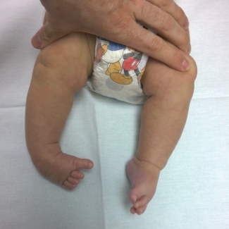 врожденная тяжелая двухсторонняя косолапость