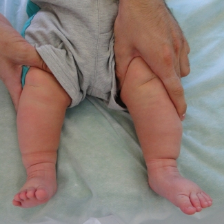 врожденная тяжелая двухсторонняя косолапость