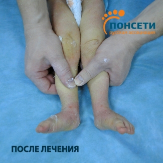 двухсторонняя косолапость