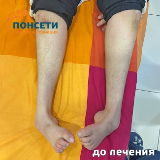 рецидив косолапости, синдром Шарко-Мари-Тута