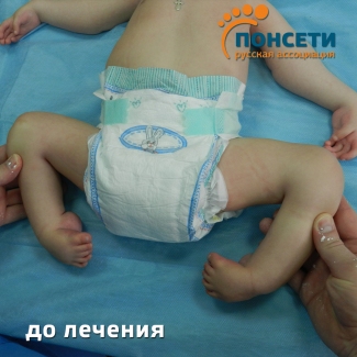 Косолапость. Артрогриппоз. Констрактура суставов стоп, коленных, тазобедренных суставов, суставов кости и локтевого сустава