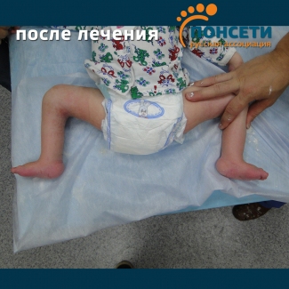 Косолапость. Артрогриппоз. Констрактура суставов стоп, коленных, тазобедренных суставов, суставов кости и локтевого сустава