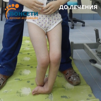 неврогенная косолапость