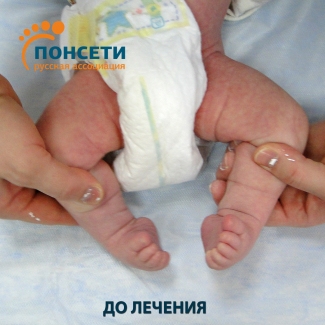 двухсторонняя косолапость