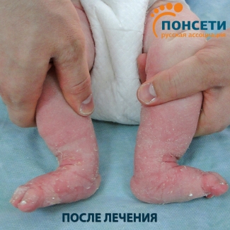 двухсторонняя косолапость двухсторонняя косолапость