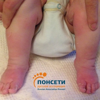 врожденная тяжелая двухсторонняя косолапость