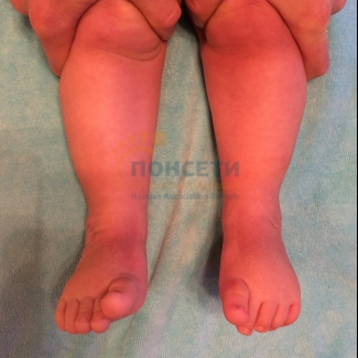 врожденная тяжелая двухсторонняя косолапость