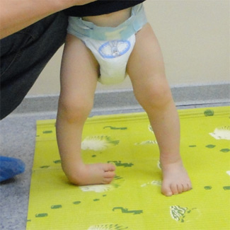 Врожденная правосторонняя косолапость (лечение проводилось в течение 8-ми недель)