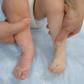 Врожденная правосторонняя косолапость (лечение проводилось в течение 8-ми недель)