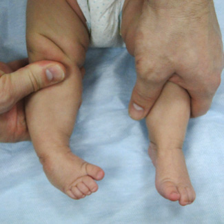 Врожденная правосторонняя косолапость