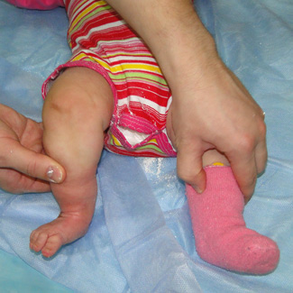 Врожденная правосторонняя косолапость