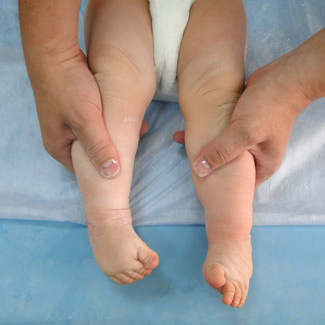 Врожденная двухсторонняя косолапость