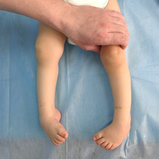 Врожденная двухсторонняя косолапость