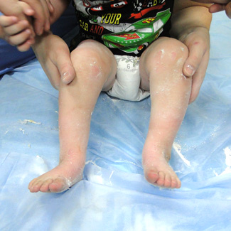 Врожденная двухсторонняя косолапость