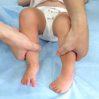 Врожденная левосторонняя косолапость