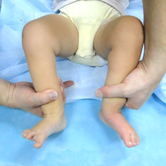 Врожденная левосторонняя косолапость