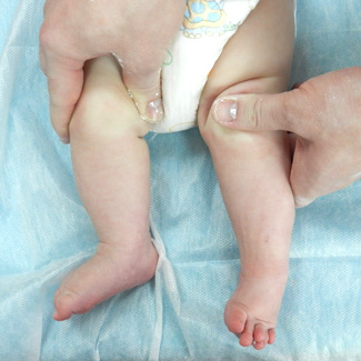 Врожденная левосторонняя косолапость