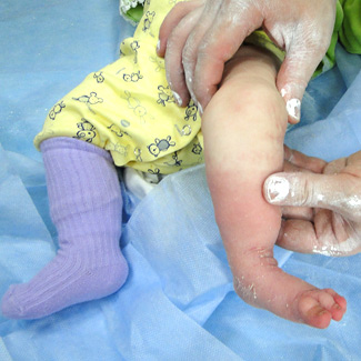 Врожденная левосторонняя косолапость