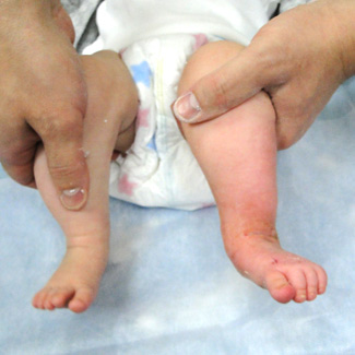 Врожденная левосторонняя косолапость