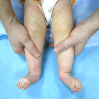 Врожденная двухсторонняя косолапость