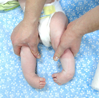 Врожденная двухсторонняя косолапость