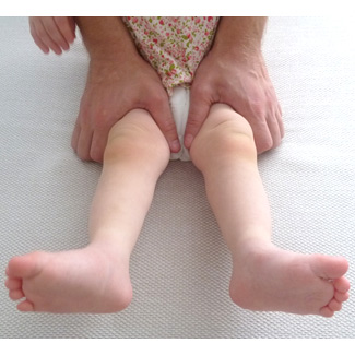 Врожденная двухсторонняя косолапость