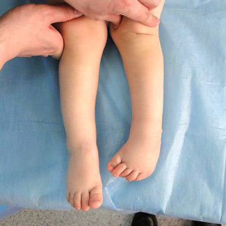 Врожденная левосторонняя косолапость