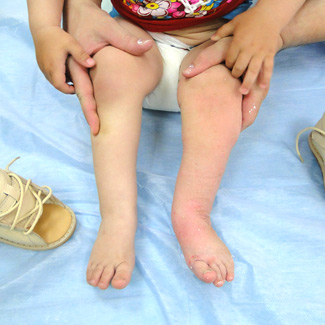 Врожденная левосторонняя косолапость