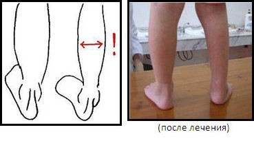 Как выглядит косолапие у детей Как определить косолапость у ребенка: основные признаки