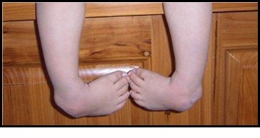 Компоненты косолапости